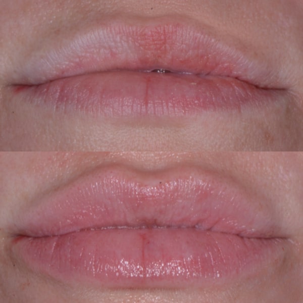 Botox Juvederm