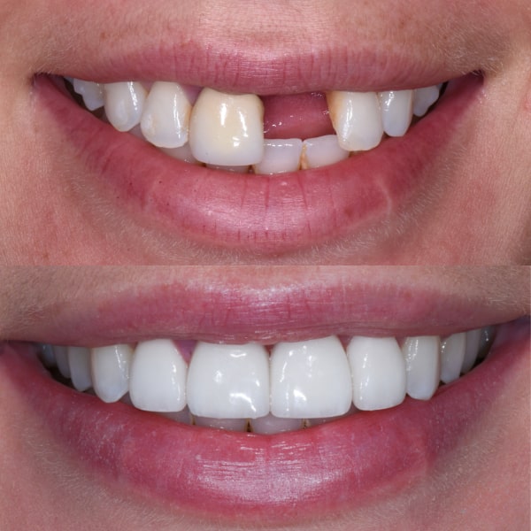 Dental Implants