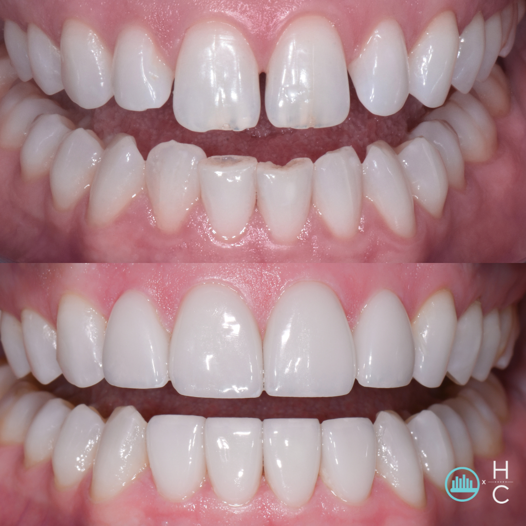 whitening