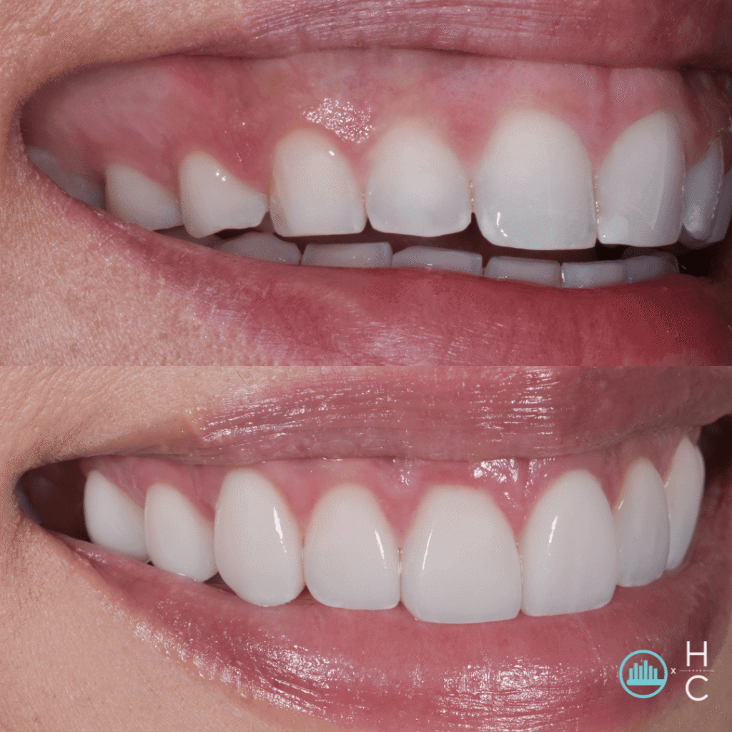 gummy smile before and after gingivectomy
